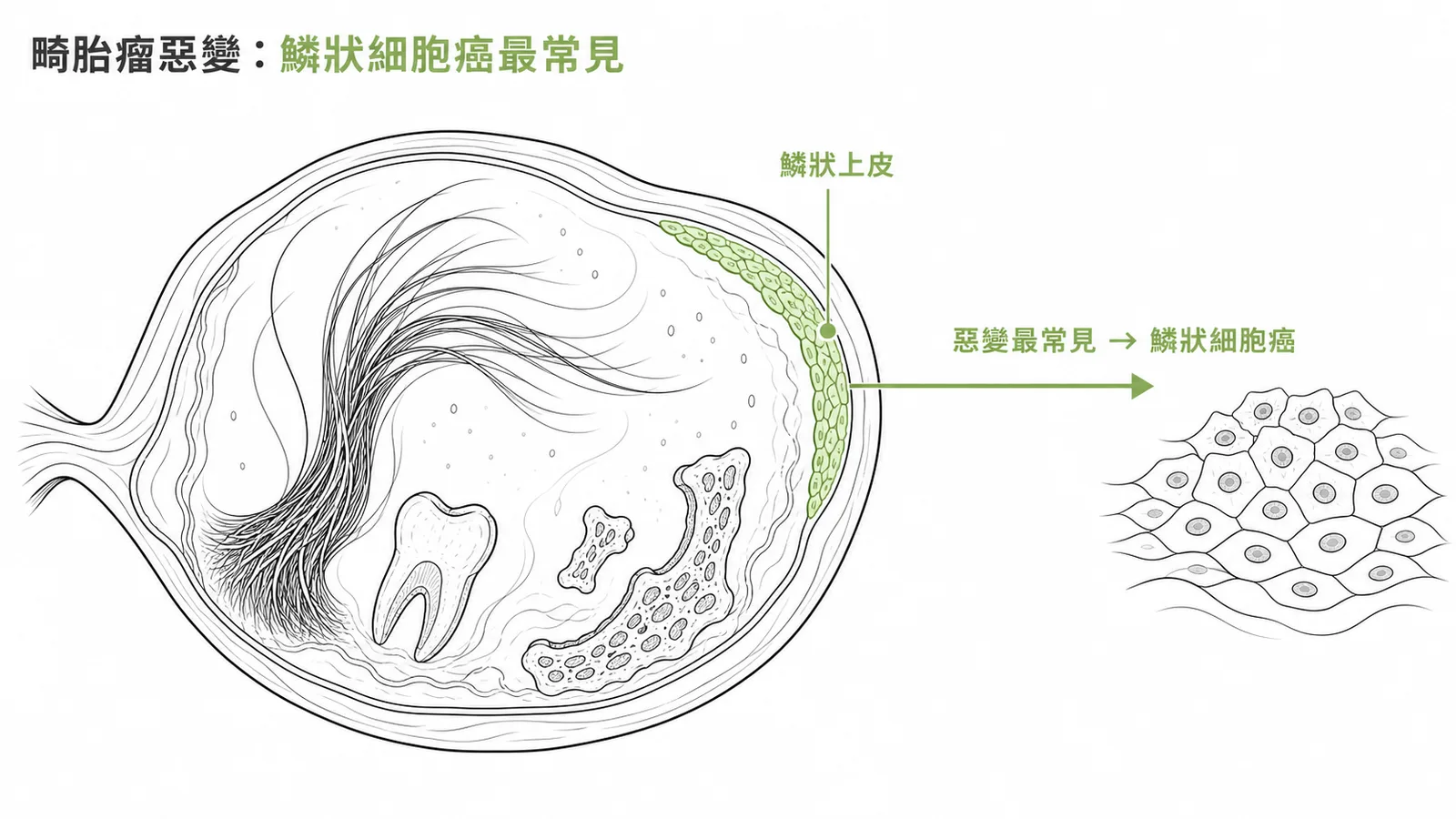 成熟卵巢畸胎瘤惡變最常見為鱗狀細胞癌，因含大量鱗狀上皮組織