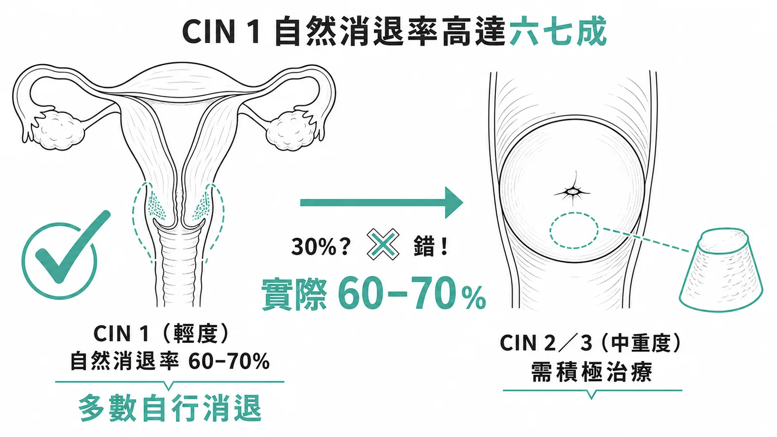 CIN 1 自然消退率高達 60-70%，非 30%；CIN 2/3 則需積極治療