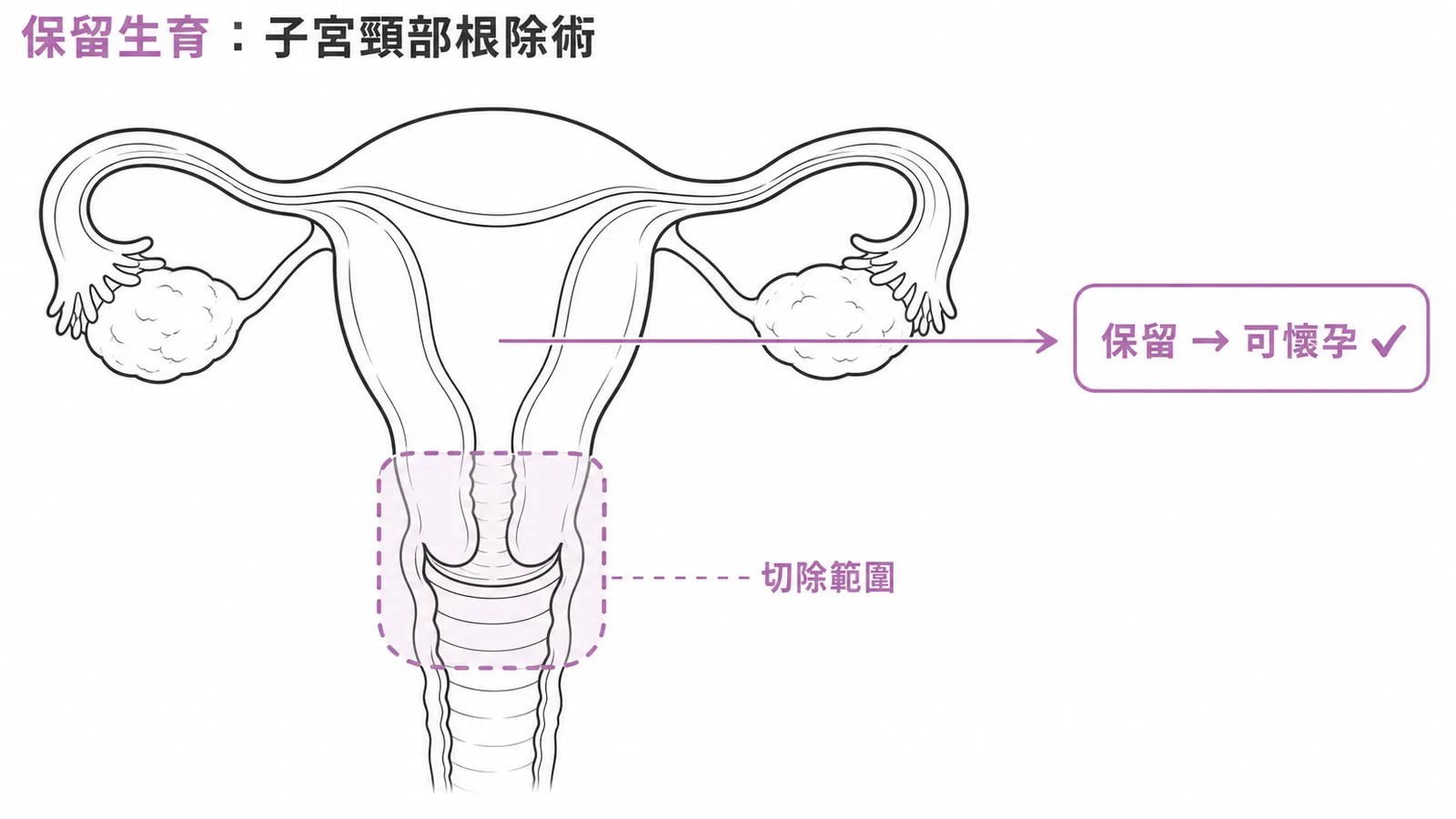 子宮頸部根除術切除子宮頸與部分陰道，保留子宮體以維持生育能力