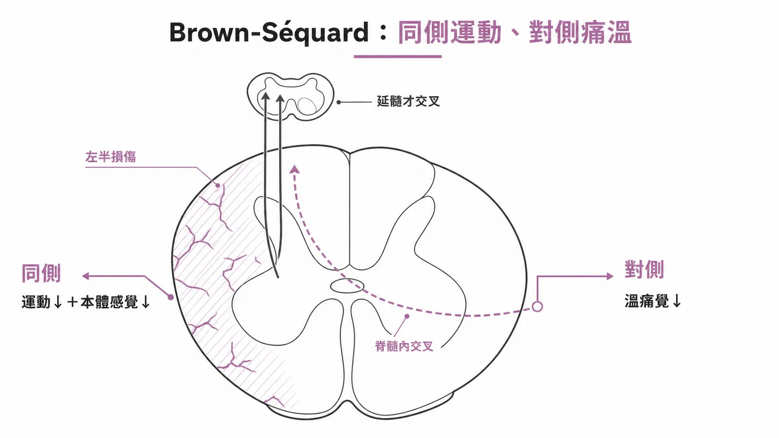 Brown-Séquard 脊髓半側損傷：同側運動與本體感覺喪失，對側溫痛覺喪失