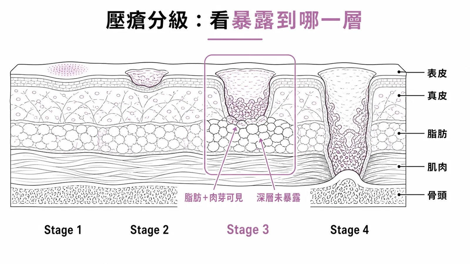 壓瘡分級依暴露深度區分，Stage 3 為全皮層缺損可見脂肪但深層組織未露