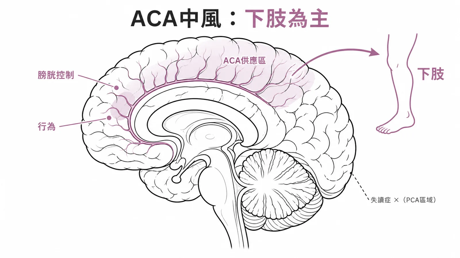 ACA 供應大腦內側面，中風以對側下肢無力為主，失讀症屬 PCA 而非 ACA