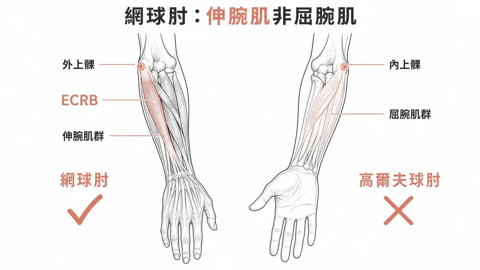 網球肘影響外上髁的伸腕肌群 ECRB，屈腕肌屬內上髁高爾夫球肘