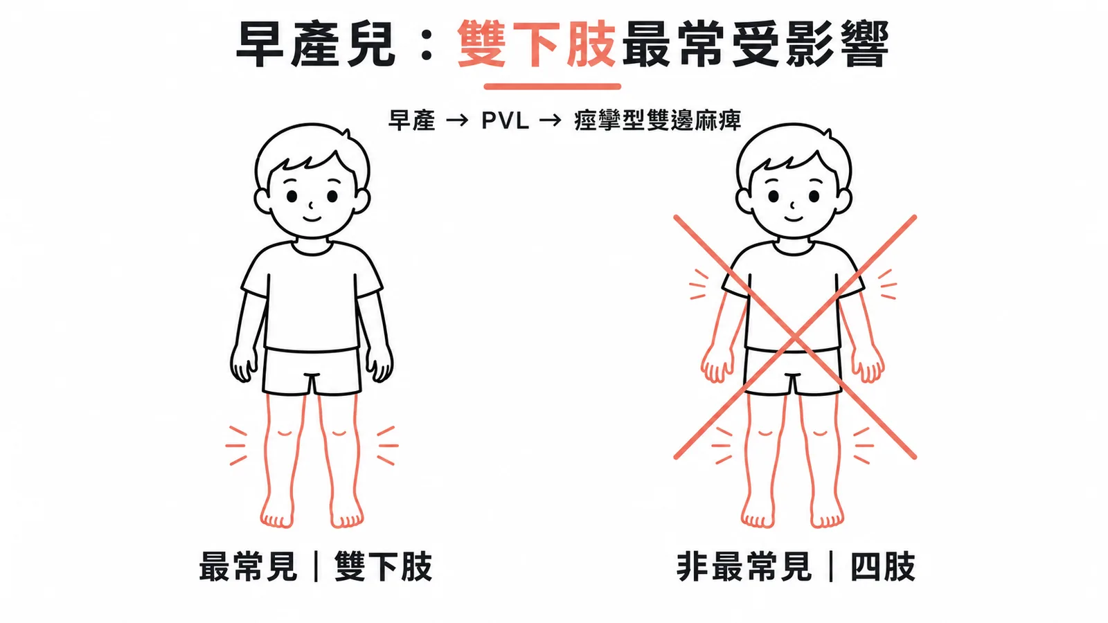 早產兒腦性麻痺以痙攣型雙邊麻痺最常見，主要影響雙下肢