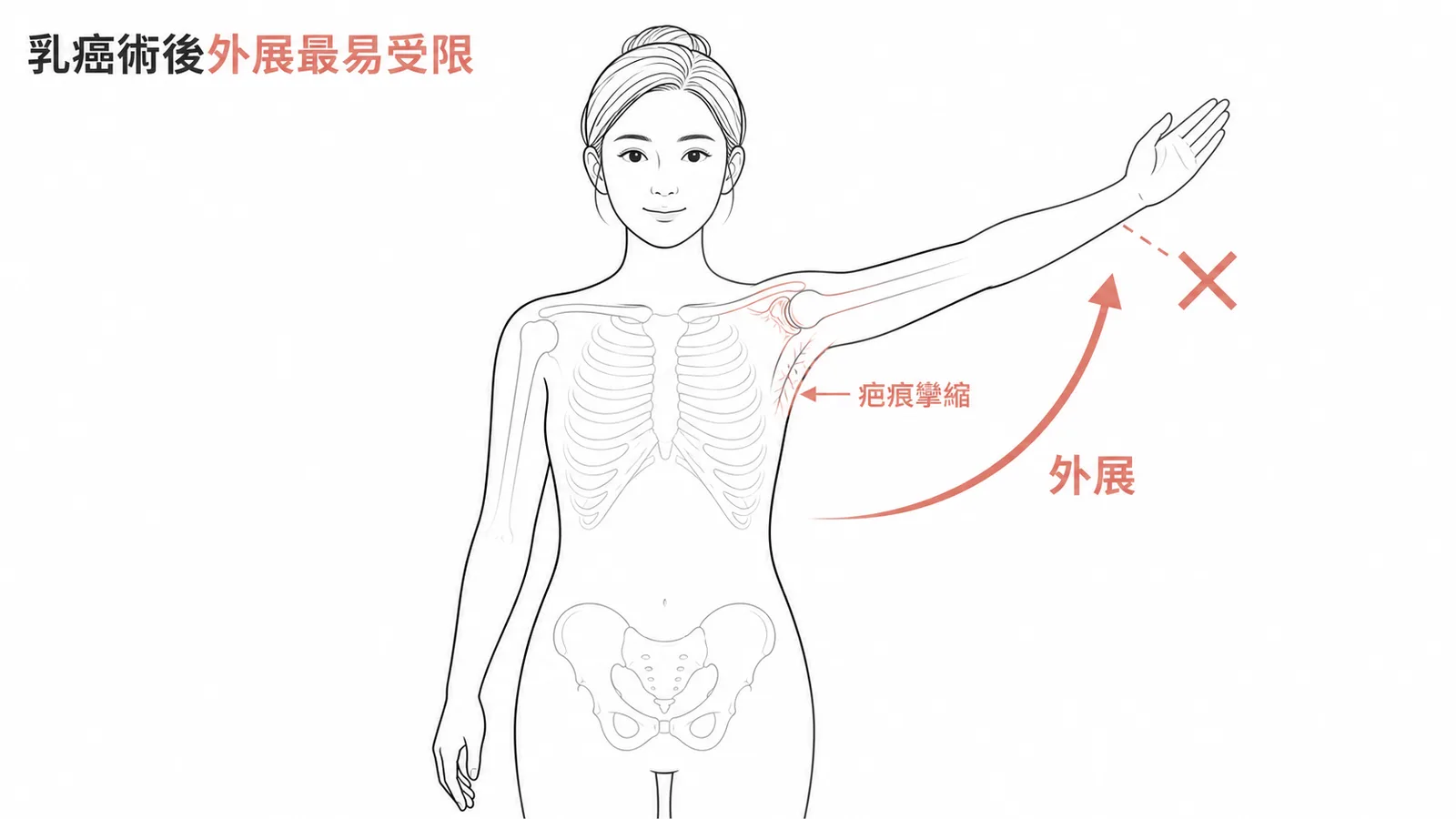 乳癌術後因疤痕攣縮與淋巴水腫導致肩關節外展最易受限