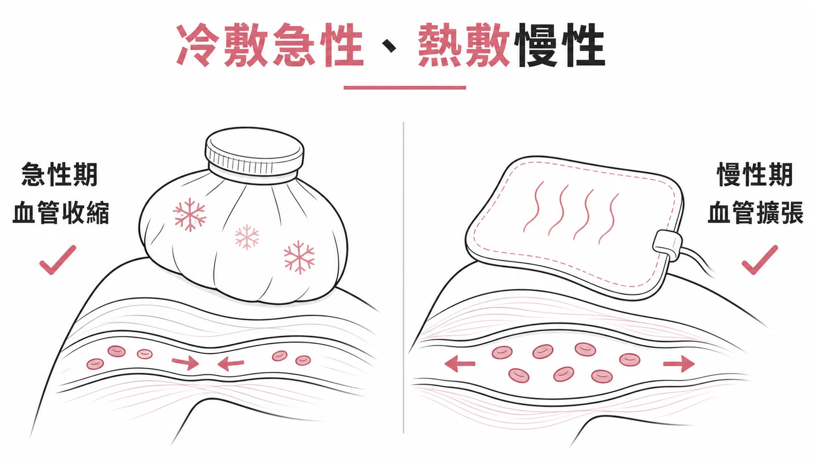 冷敷用於急性期收縮血管止痛,熱敷用於慢性期擴張血管放鬆