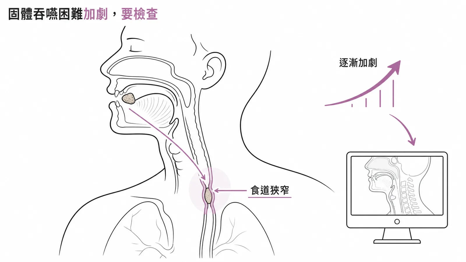 固體食物吞嚥困難且逐漸加劇需安排吞嚥影像檢查