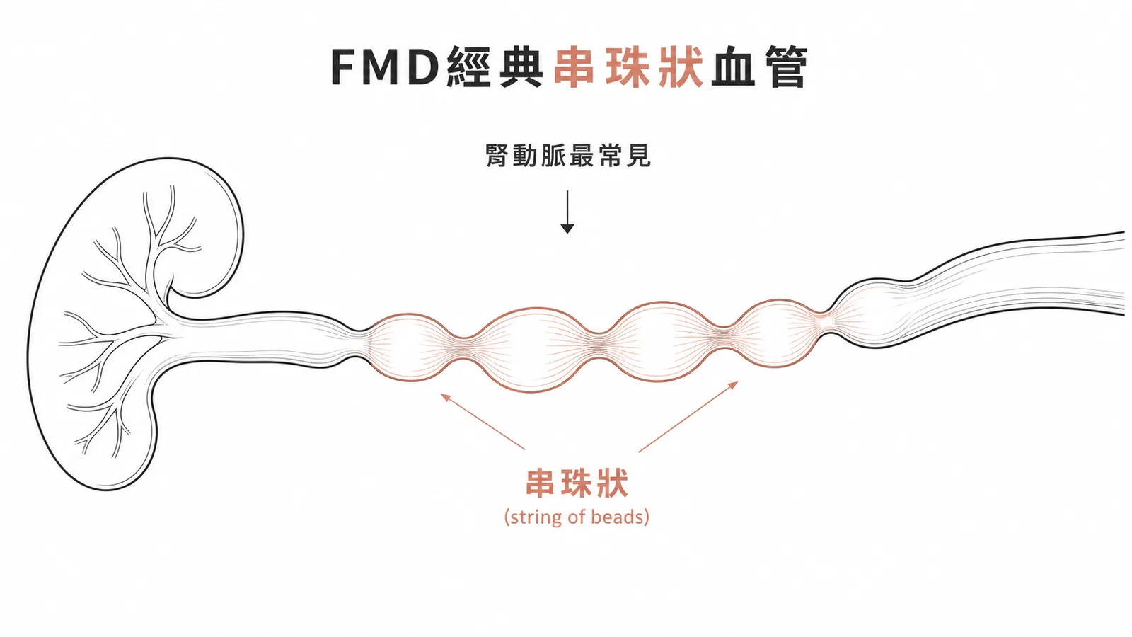 肌纖維發育不全FMD腎動脈血管攝影呈串珠狀外觀