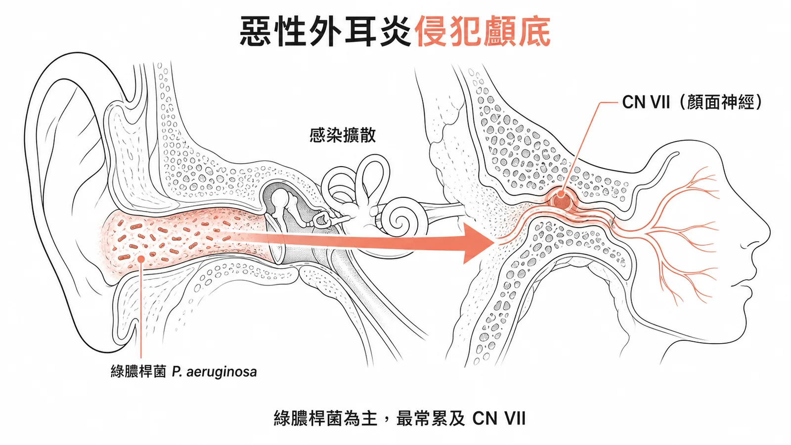 惡性外耳炎從外耳道侵犯顱底並累及第七對腦神經的示意圖