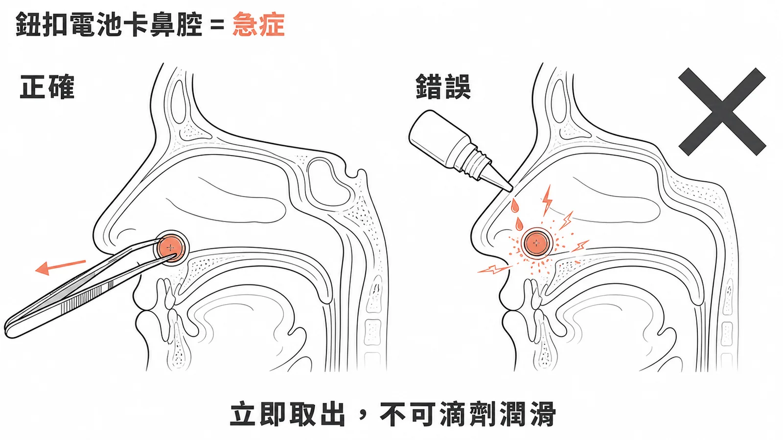 鈕扣電池卡鼻腔須立即取出不可用滴劑潤滑的對照示意圖
