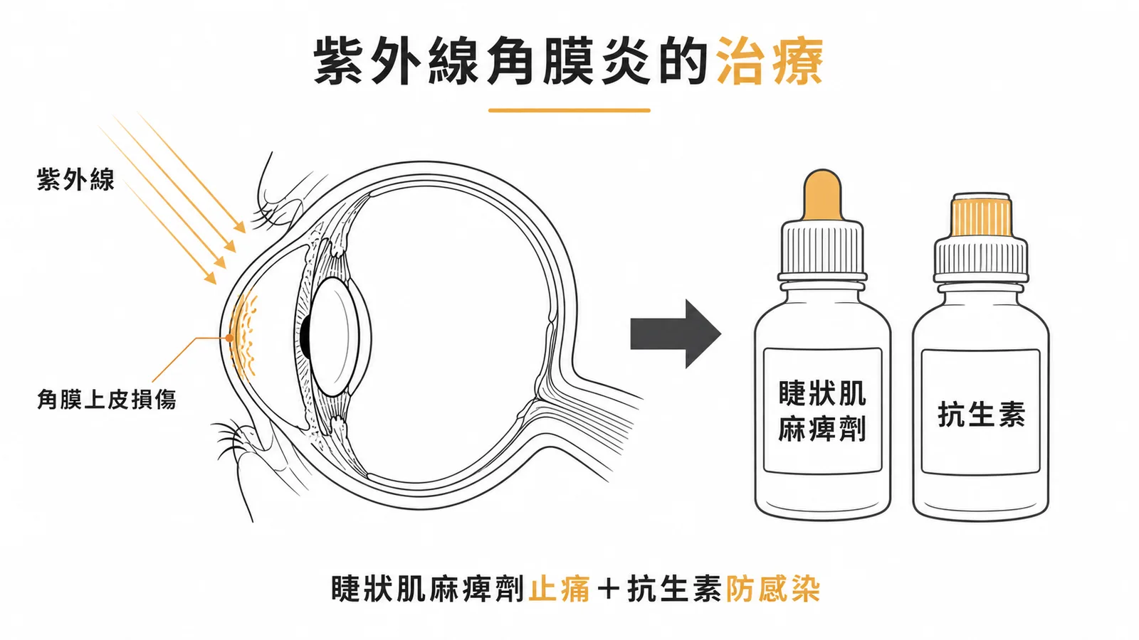 紫外線角膜炎治療示意圖：睫狀肌麻痺劑止痛加抗生素防感染