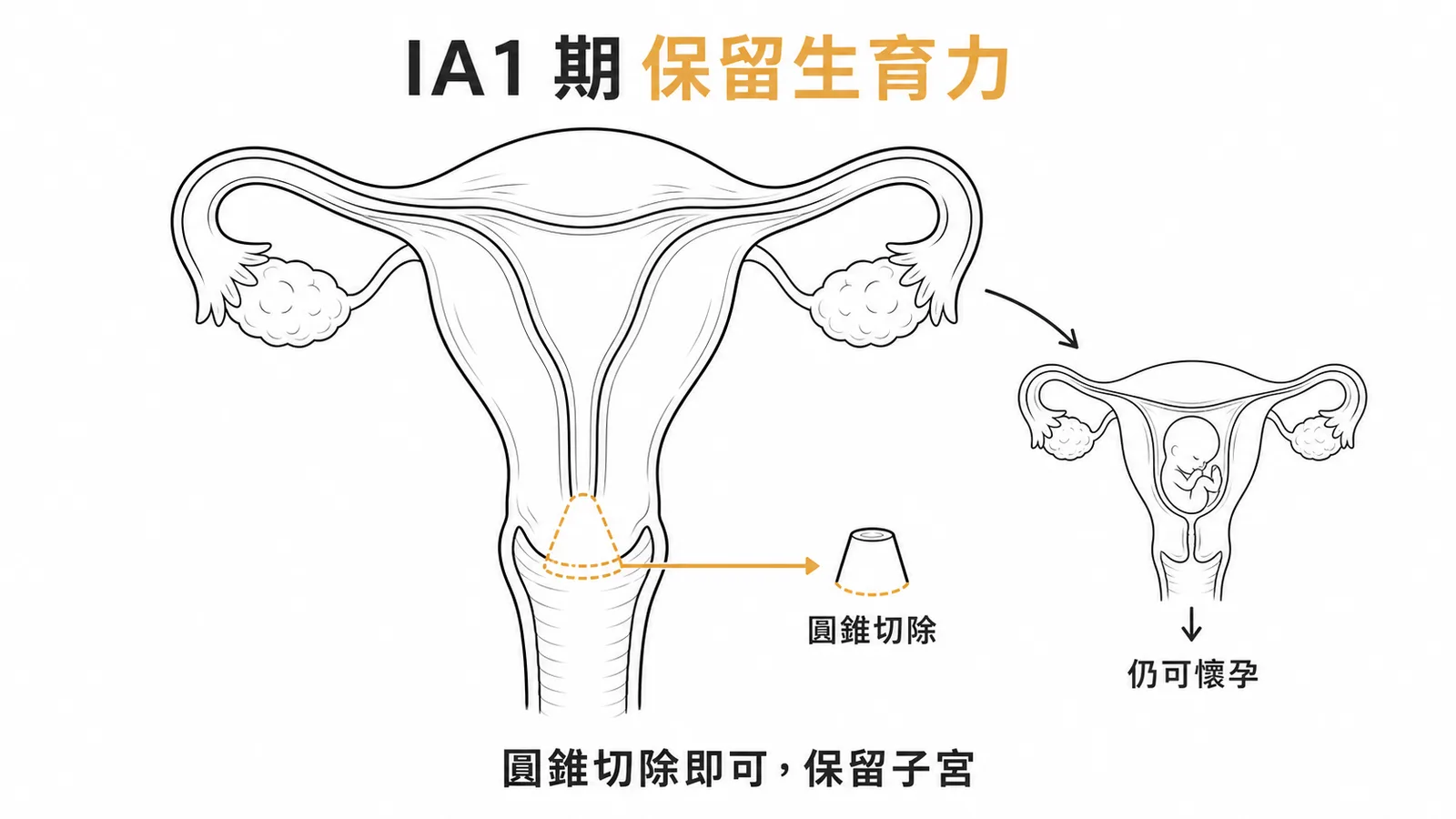 子宮頸癌 IA1 期圓錐切除保留子宮的示意圖