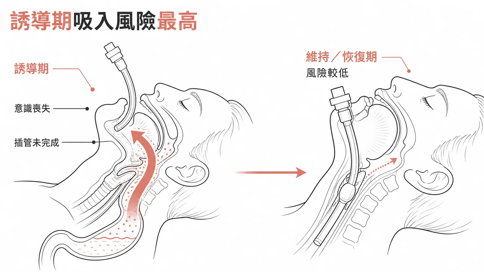 全身麻醉誘導期吸入性肺炎風險最高示意圖