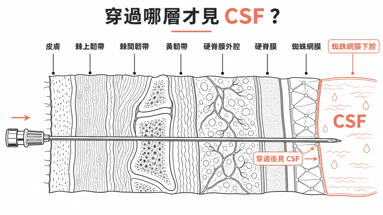 脊椎麻醉穿刺層次：穿過蜘蛛網膜才見 CSF