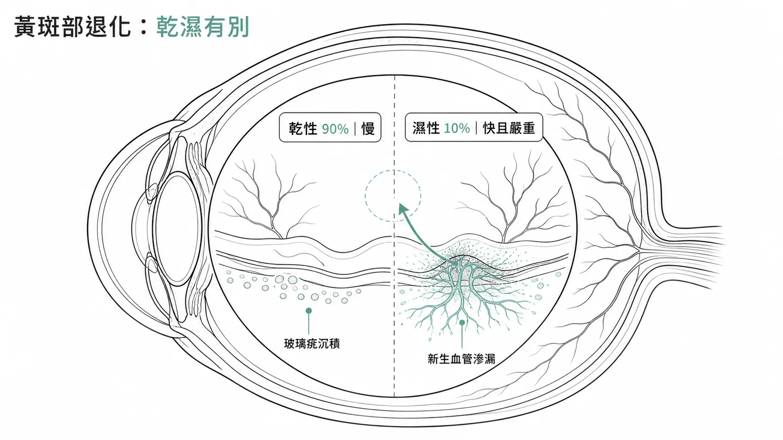 AMD 乾性 vs 濕性比較：乾性佔 90% 進展慢，濕性佔 10% 但新生血管致快速嚴重視力喪失