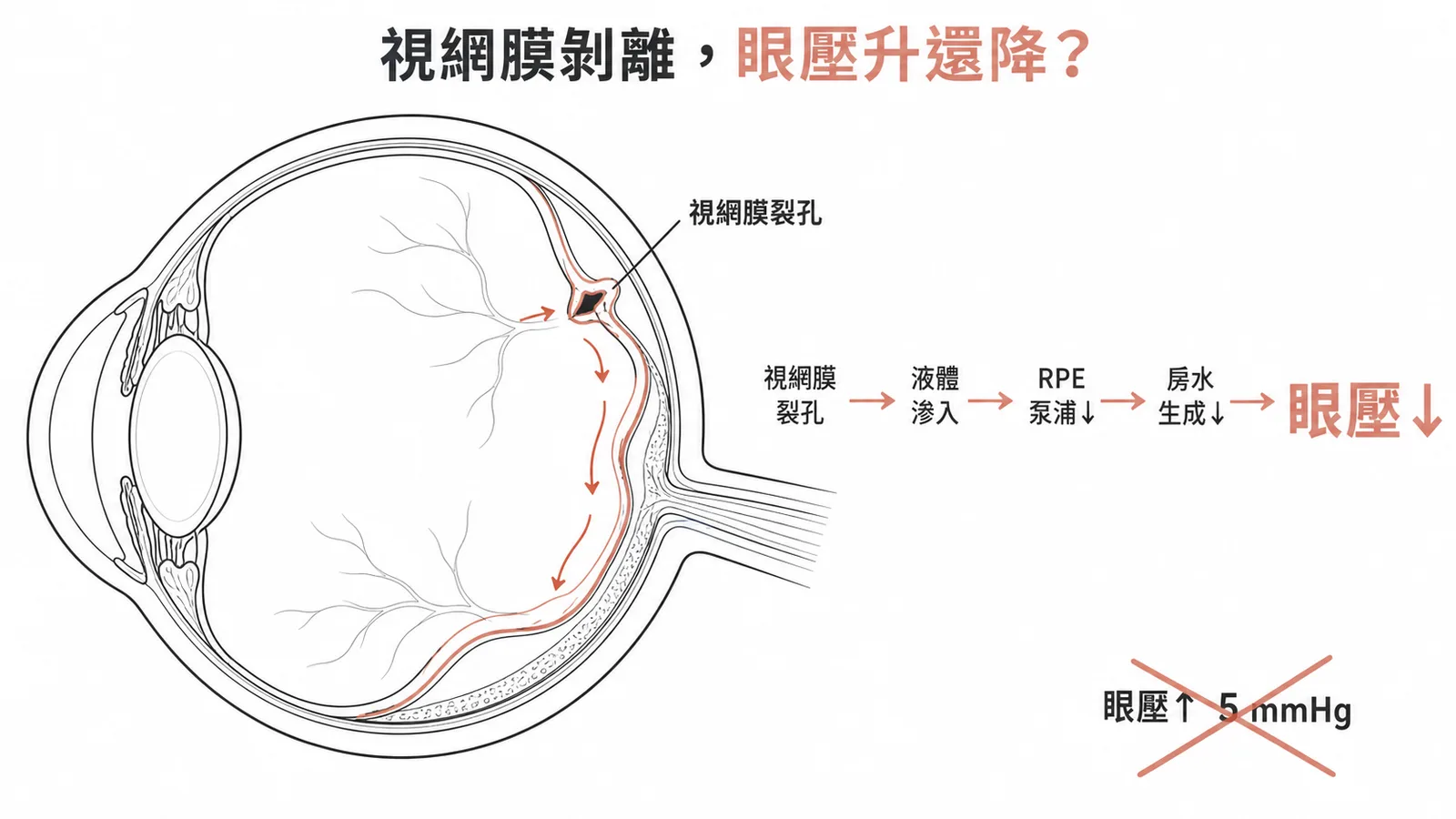 裂孔性視網膜剝離眼壓變化：裂孔→液體滲入→RPE 泵浦受損→眼壓降低而非升高
