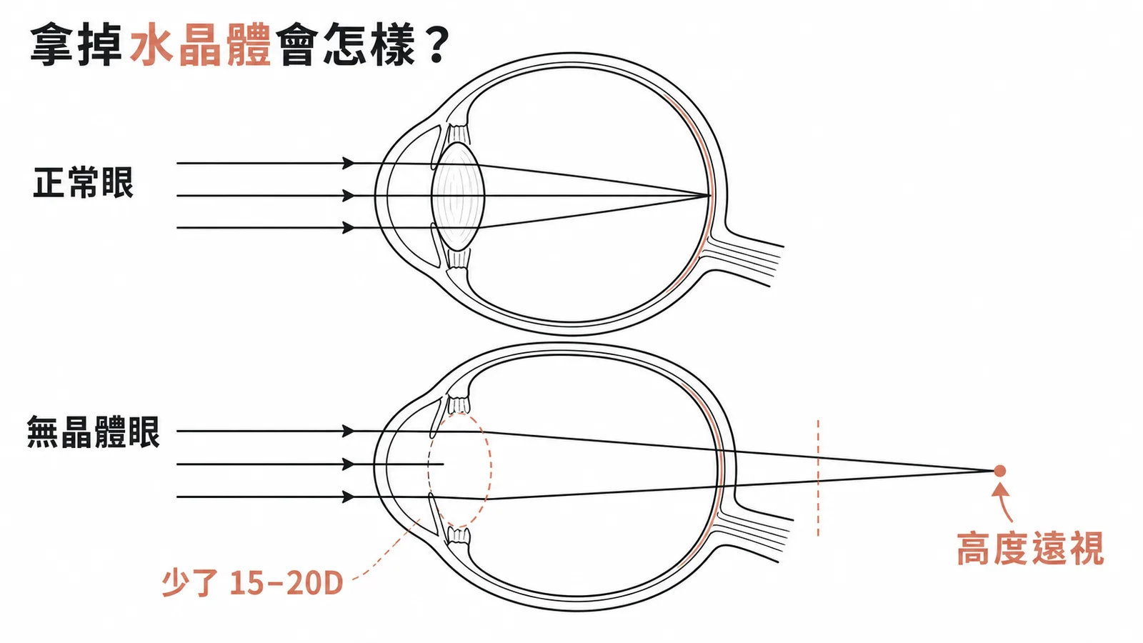 無晶體眼屈光變化：取出水晶體失去 15-20D 屈光力，光線聚焦於視網膜後方造成高度遠視
