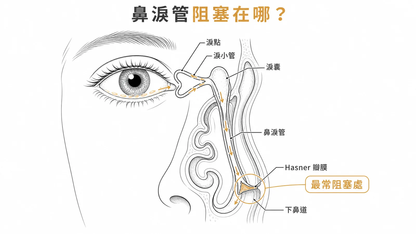 鼻淚管解剖：淚點→淚小管→淚囊→鼻淚管→Hasner 瓣膜（最常阻塞處）→下鼻道出口