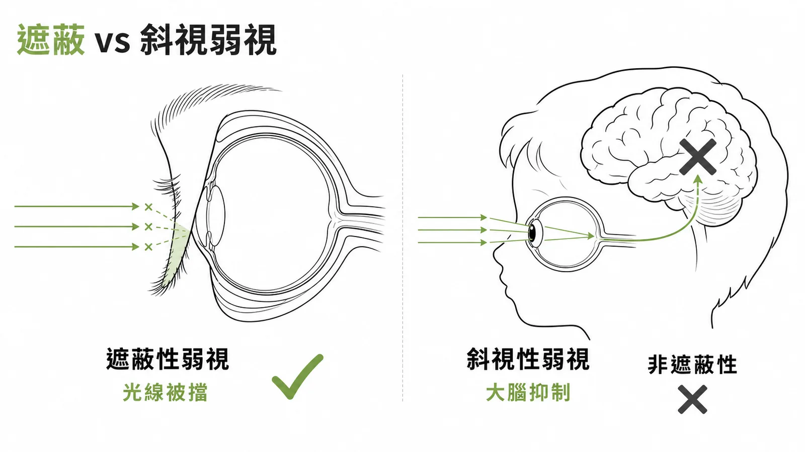 遮蔽性弱視 vs 斜視性弱視：遮蔽性是光線被物理阻擋，斜視性是大腦抑制——兩者機轉不同