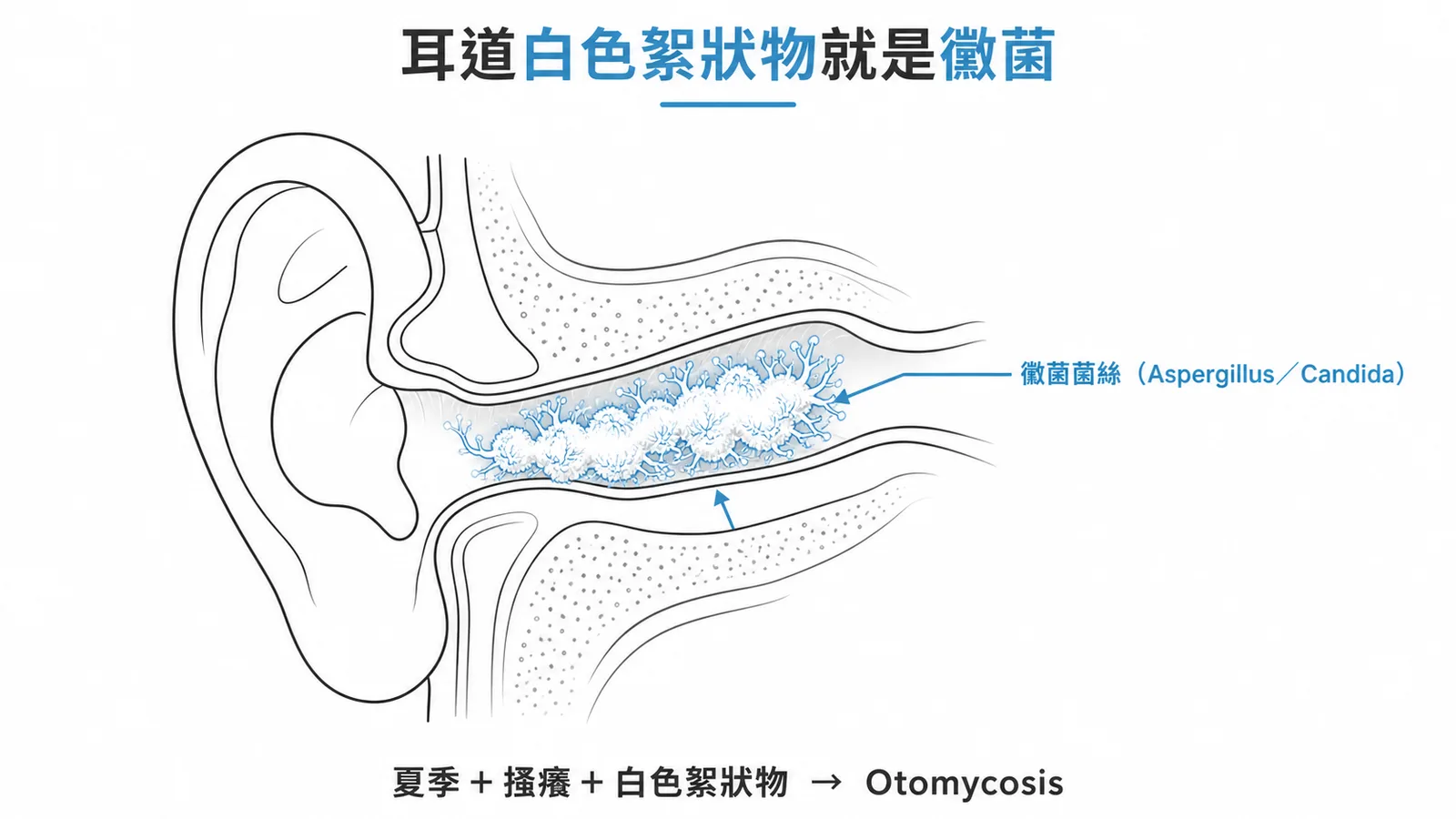 黴菌性外耳炎:耳道白色絮狀菌絲為 Otomycosis 典型表現