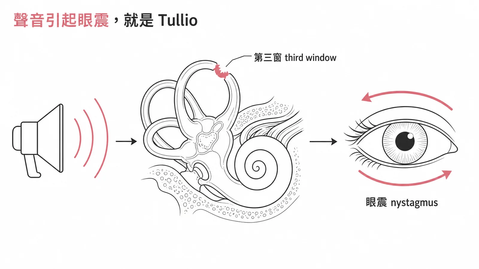 Tullio phenomenon：聲音經第三窗異常刺激半規管引起眼震