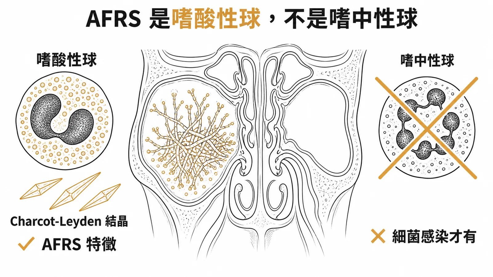AFRS 組織病理是嗜酸性球浸潤,非嗜中性球