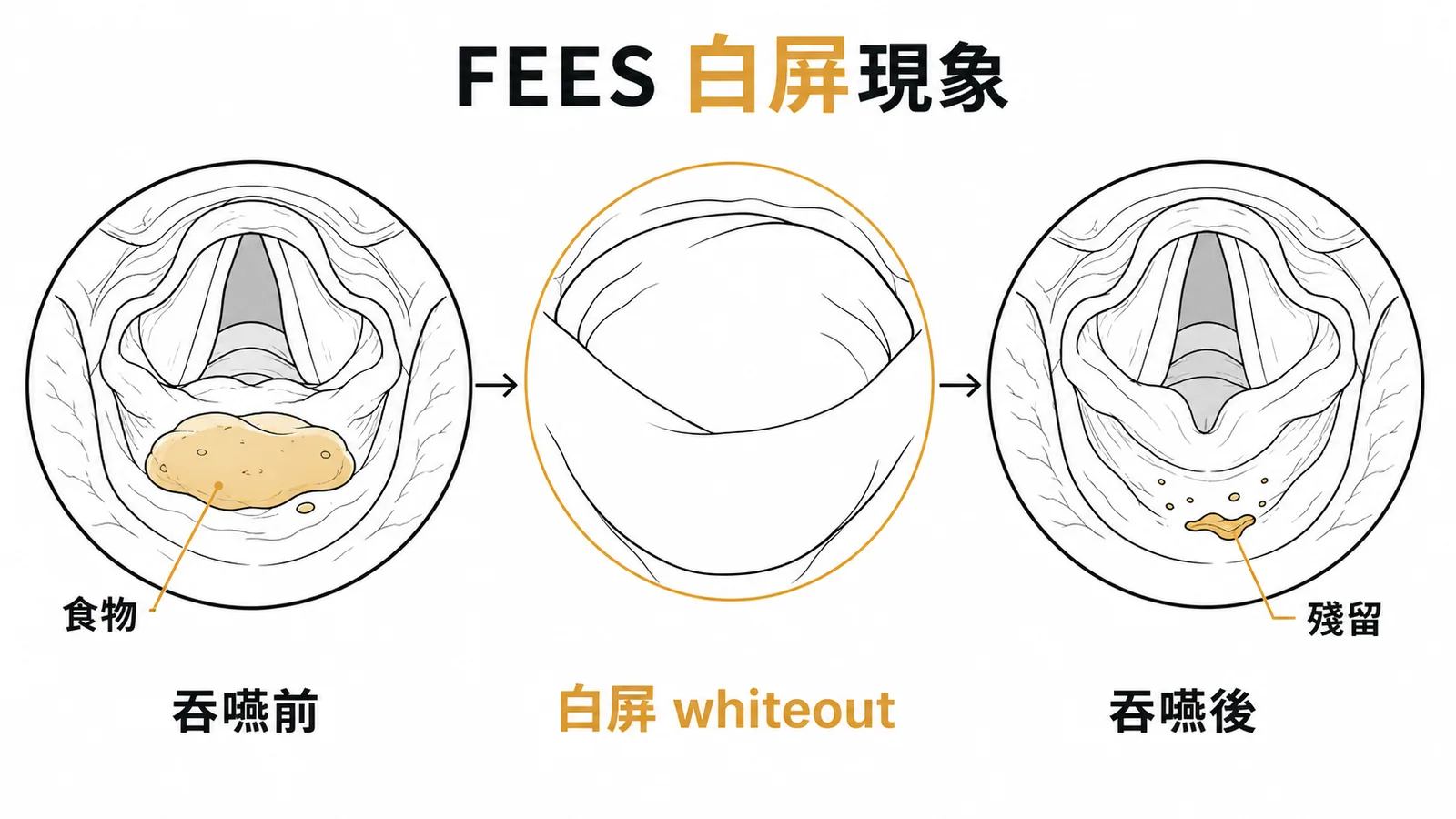 FEES吞嚥檢查白屏現象三階段示意圖