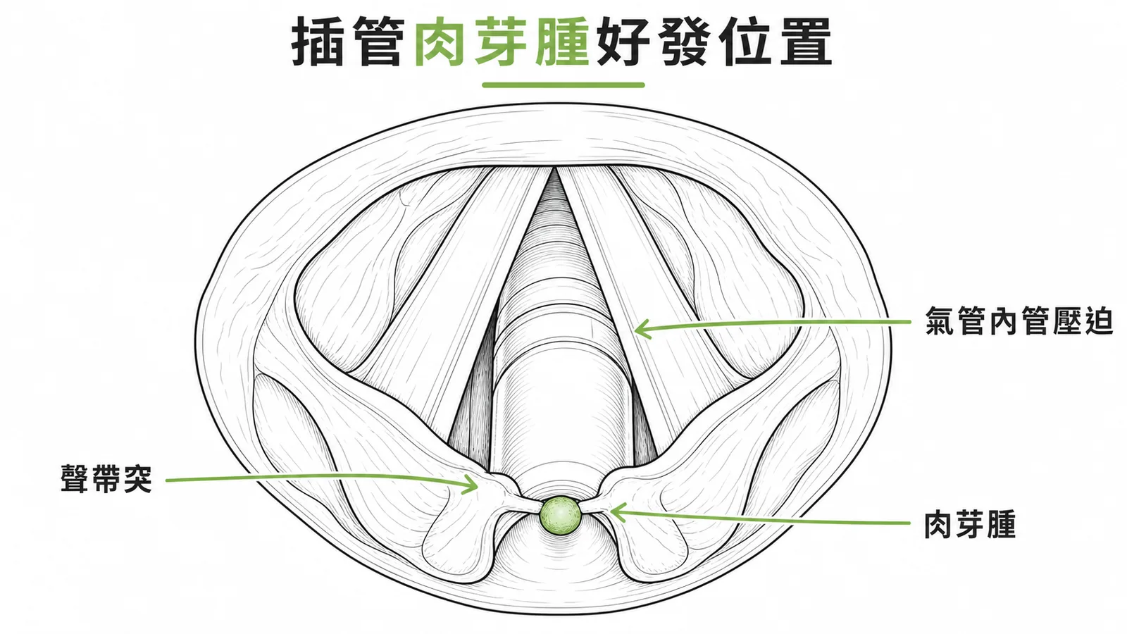 插管肉芽腫好發於杓狀軟骨聲帶突位置示意圖