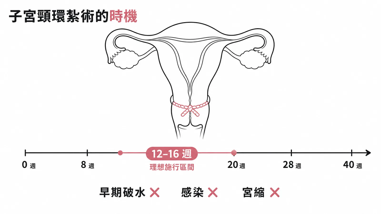 預防性子宮頸環紮術施行時機與禁忌症示意圖