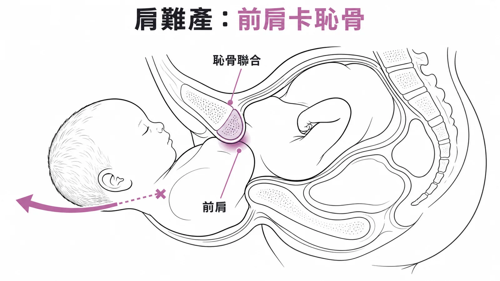 肩難產機制示意圖：前肩卡在恥骨聯合