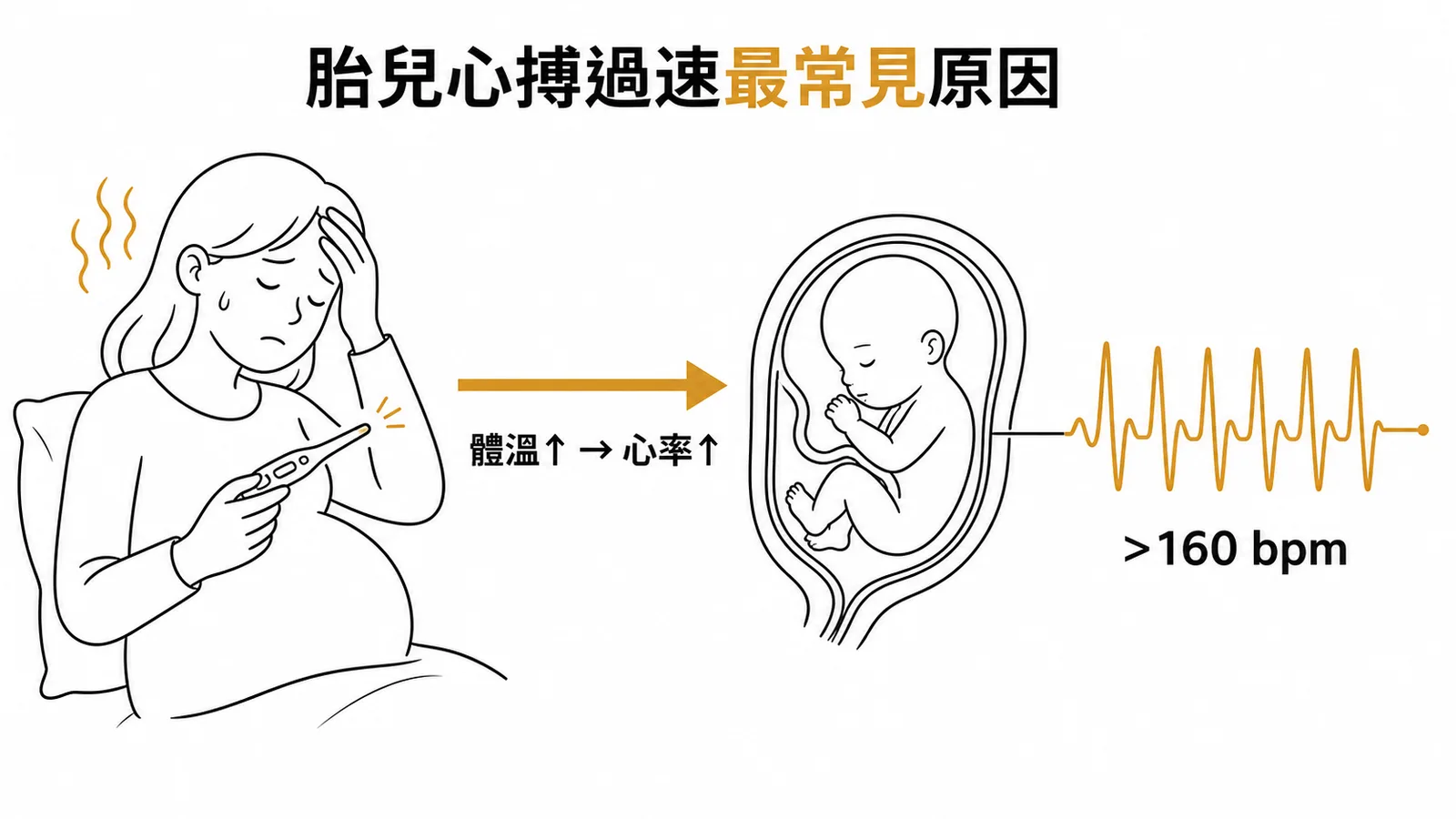 胎兒心搏過速最常見原因：母親發燒導致體溫升高連帶胎兒心率加速