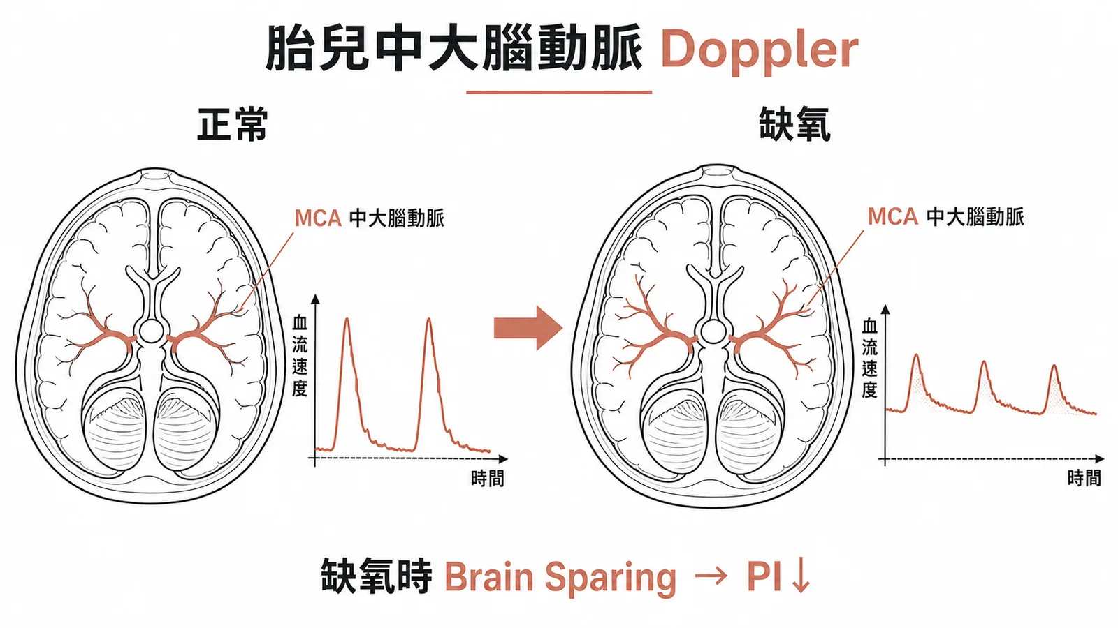 胎兒中大腦動脈Doppler：正常與缺氧時MCA波形對比及Brain Sparing效應