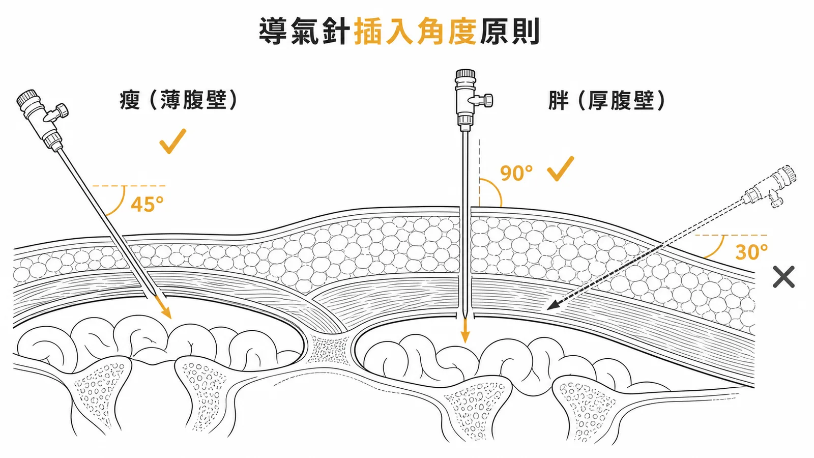 導氣針插入角度原則：瘦病人45度胖病人90度而30度太小