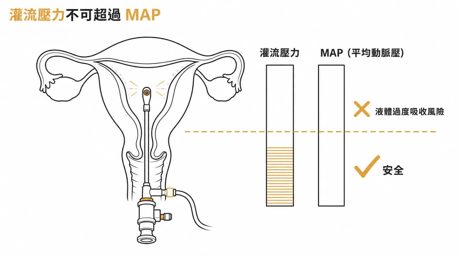 子宮鏡灌流壓力不可超過MAP以避免液體過度吸收