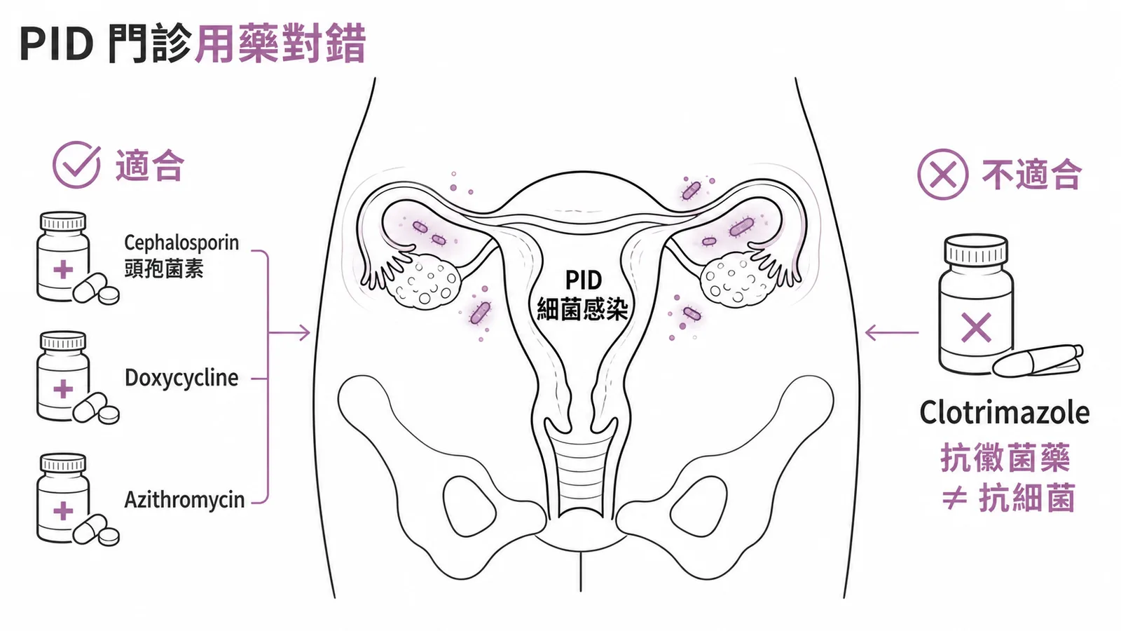 PID門診用藥對比：抗生素適合而抗黴菌藥clotrimazole不適合