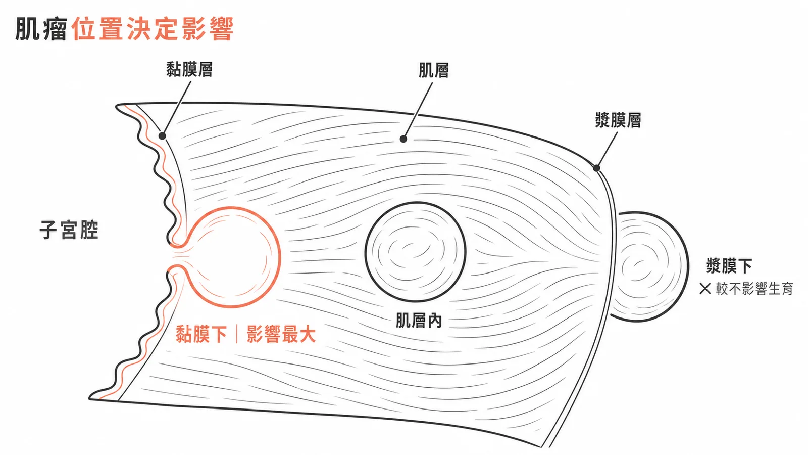 子宮肌瘤三型位置與對生育影響的差異示意圖