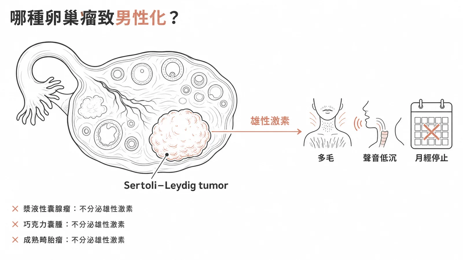 Sertoli-Leydig tumor 分泌雄性激素導致男性化症狀