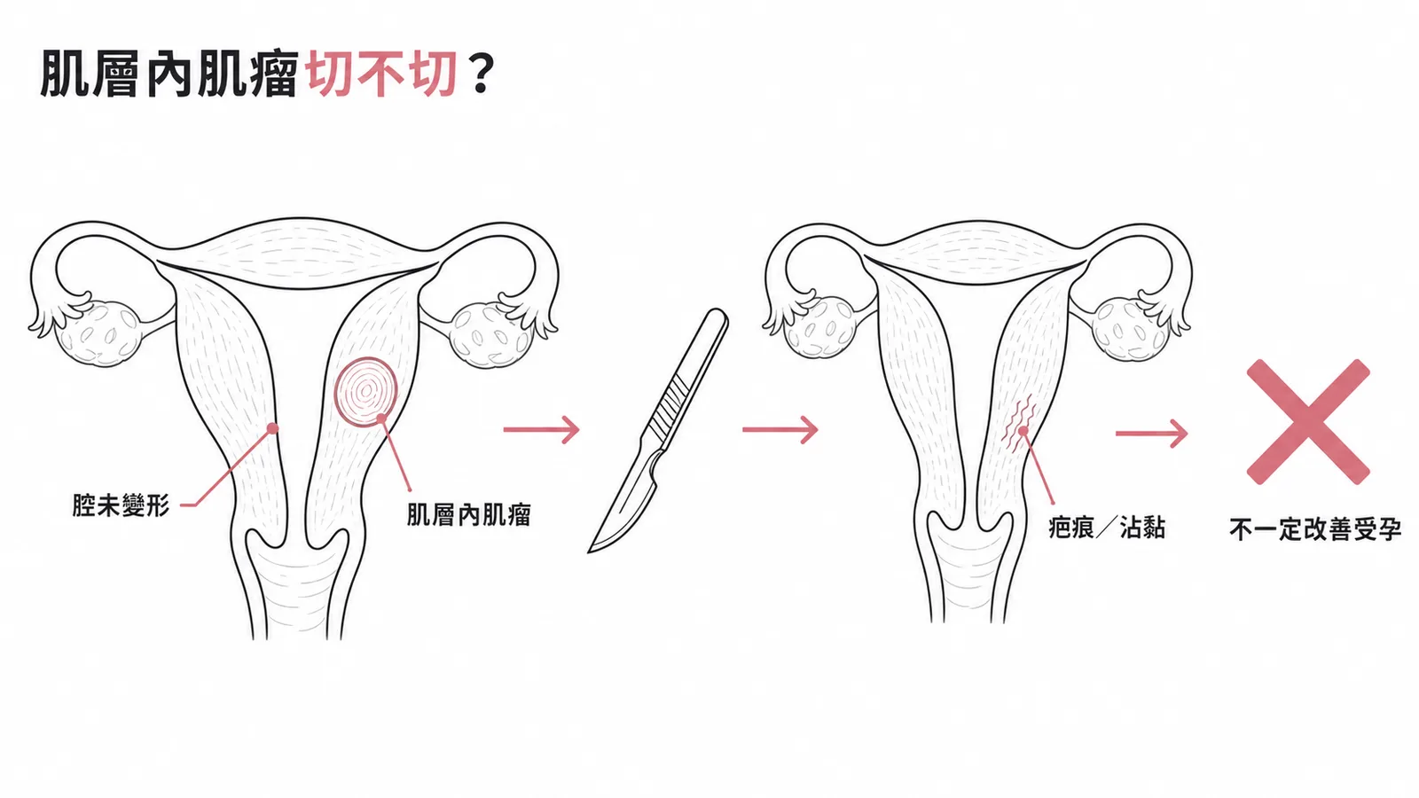 肌層內肌瘤未扭曲子宮腔時切除不一定改善受孕