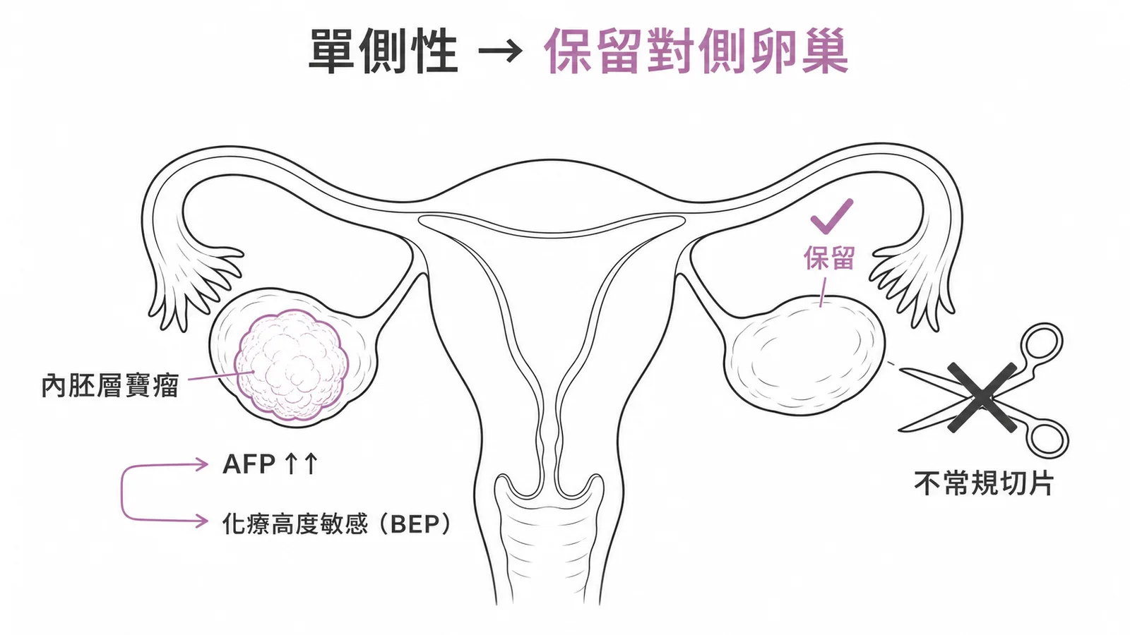 內胚層竇瘤單側性保留對側卵巢不常規切片