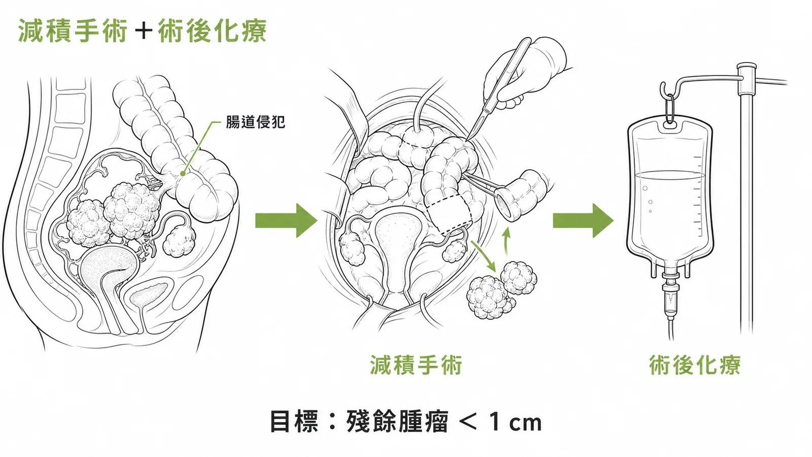 晚期卵巢癌減積手術切除受侵犯腸段後接術後化療