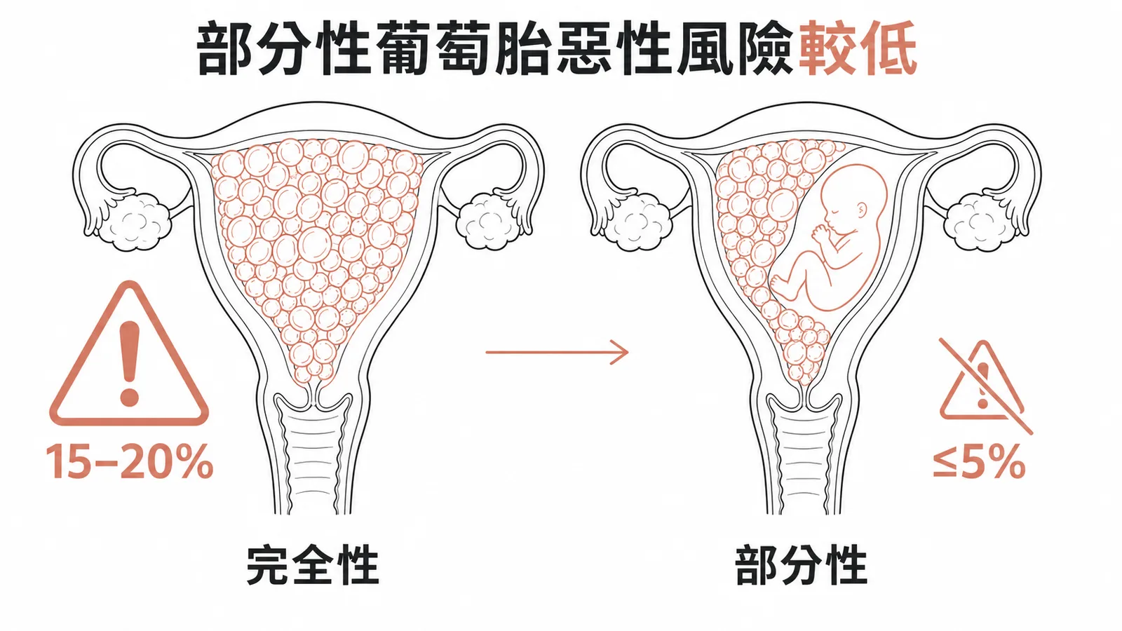 部分性葡萄胎惡性風險低於完全性葡萄胎