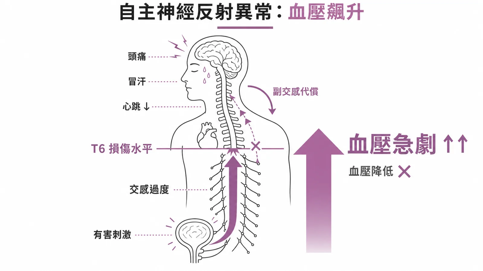 自主神經反射異常機轉:T6以上損傷致交感過度反應,血壓急劇飆升