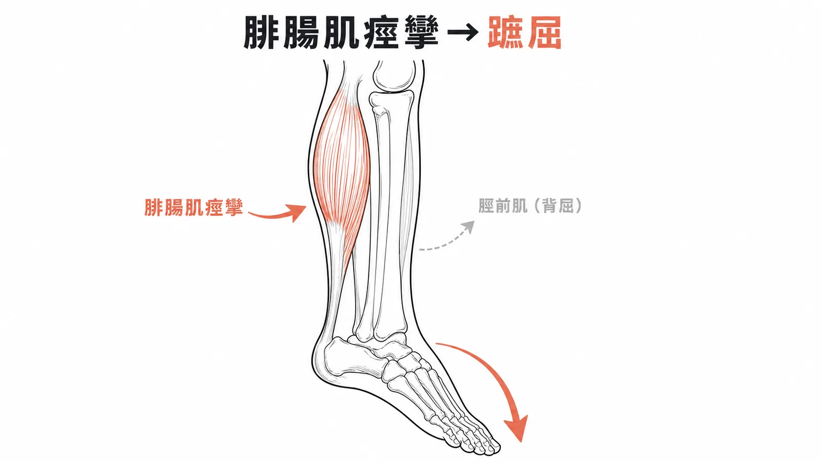 腓腸肌痙攣導致踝關節蹠屈的機轉示意