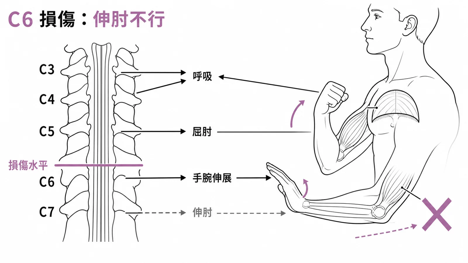 頸髓損傷節段與肌肉支配對應:C6損傷後C7肱三頭肌功能喪失
