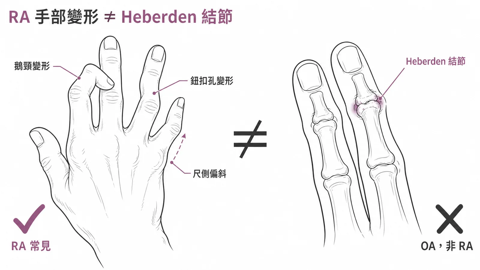 RA 典型手部變形(鵝頸、鈕扣孔、尺側偏斜)對照 OA 的 Heberden 結節