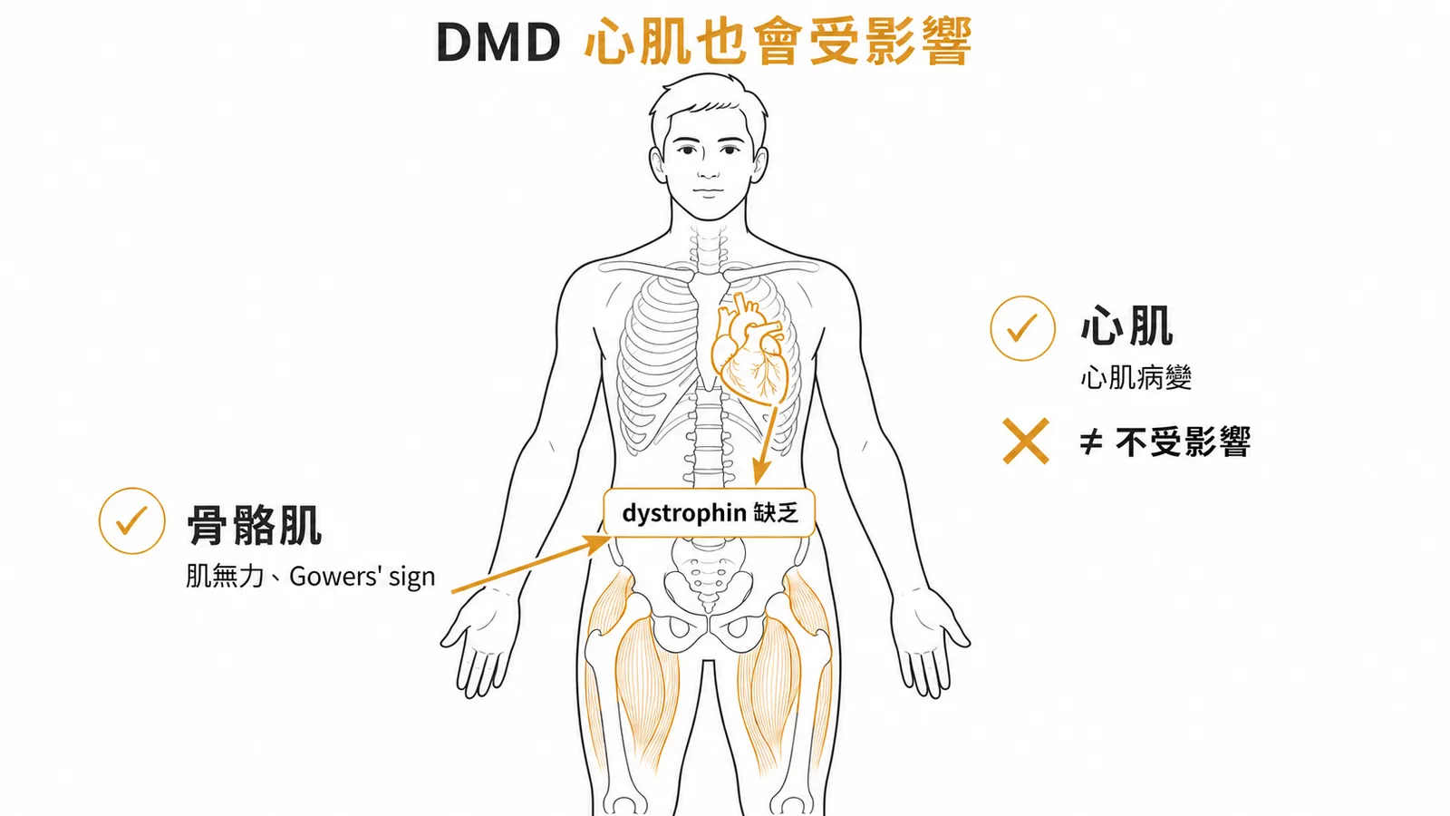 DMD dystrophin 缺乏同時影響骨骼肌與心肌,心臟並非不受影響