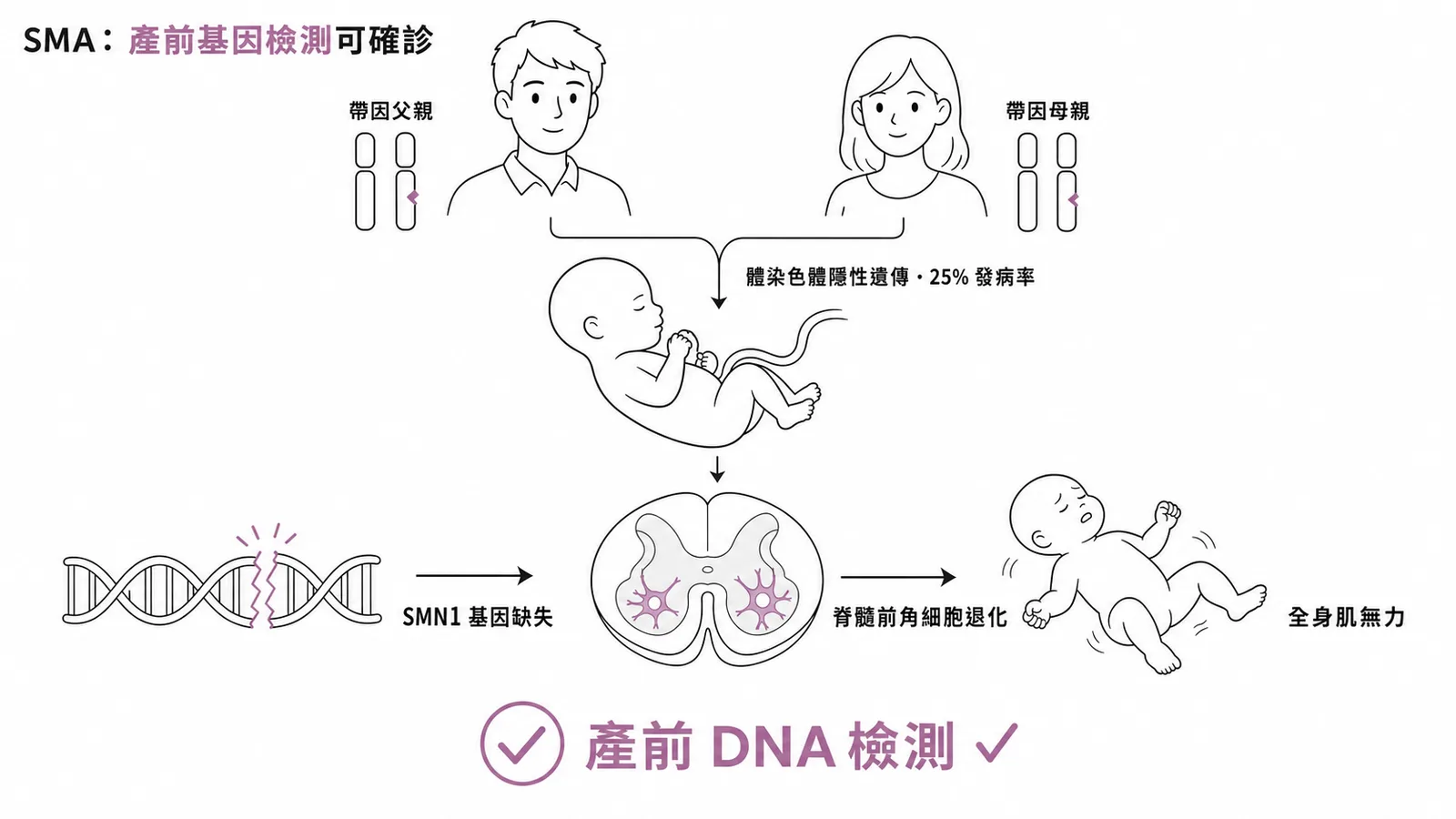 SMA 帶因父母 AR 遺傳、SMN1 缺失導致前角細胞退化，產前 DNA 可確診