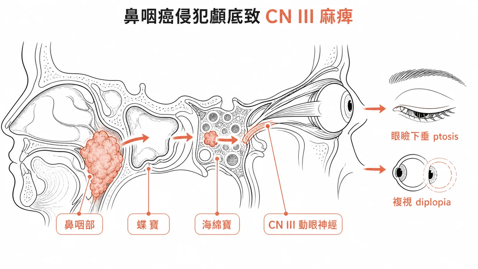 鼻咽癌侵犯路徑：鼻咽→蝶竇→海綿竇→CN III 動眼神經麻痺