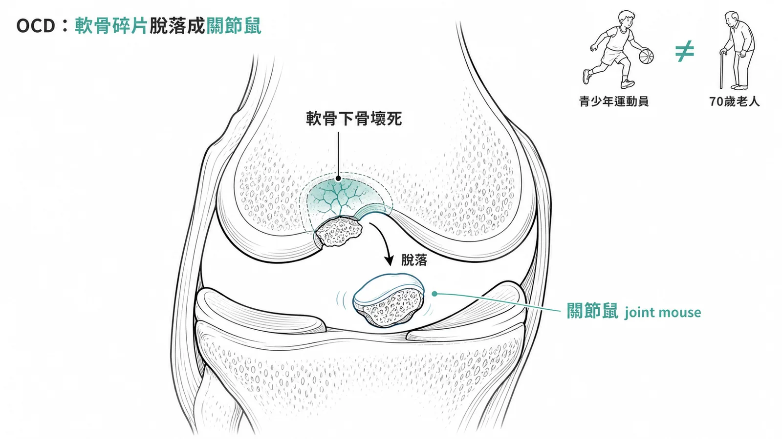 OCD 膝關節剖面:軟骨下骨壞死碎片脫落成關節鼠,好發青少年非老人