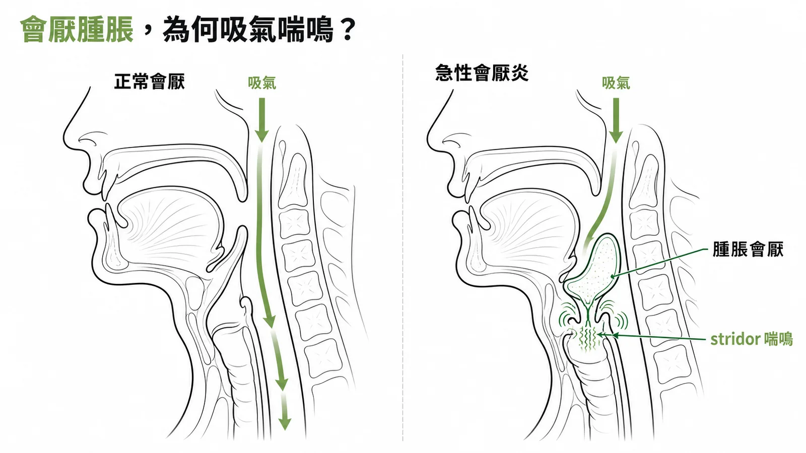 急性會厭炎：會厭腫脹導致氣道狹窄產生吸氣喘鳴聲
